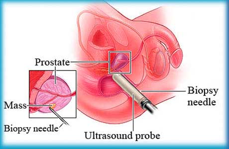 Needle Biopsy of the Prostate cancer