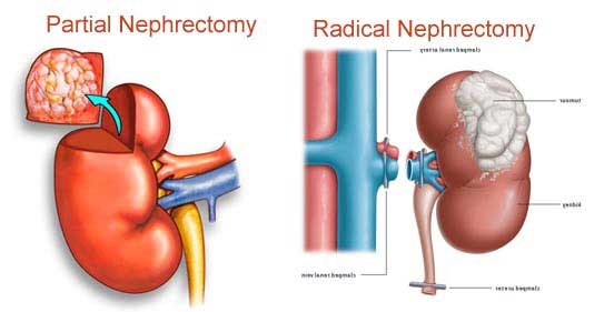 Nephrectomy Surgery in India