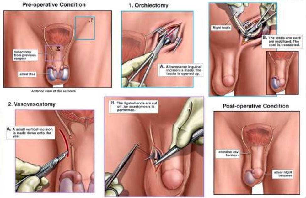 Orchiectomy Treatment Surgery Cost in Mumbai Chennai Delhi Kolkata Hyderabad Bangalore Pune Ahmedabad India