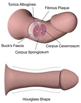 images - Peyronie Disease Overview causes symptoms and treatment in- India