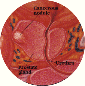 Prostate cancer Stage B describes