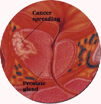 Prostate cancer Stage c describes
