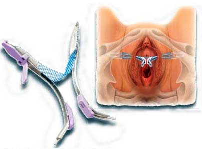 GYNECARE TVT