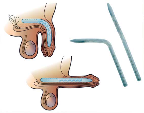 Coloplast Genesis – 1 piece Malleable Penile Implant India cost Surgery Hospital Mumbai, Chennai, Delhi, Kolkata, Hyderabad, Bangalore, Pune, Ahmedabad in India