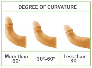 Is surgery a good option for correcting a curved penis?