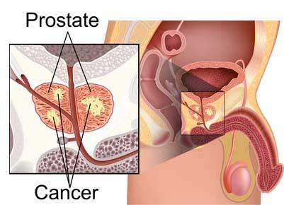 ED diseases and conditions -  Cancer in prostate cancer and inflamed prostate management