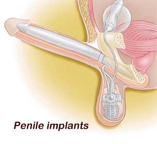 Fda approves cialis to treat enlarged prostate   webmd