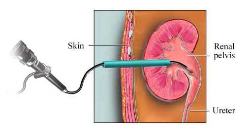 Percutaneous Nephrolithotomy Treatment Surgery Cost in Mumbai Chennai Delhi Kolkata Hyderabad Bangalore Pune Ahmedabad India