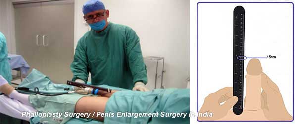 Penis Enlargment Surgery Cost 115