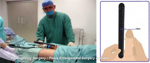 Penis Enlargement Surgery Price 100