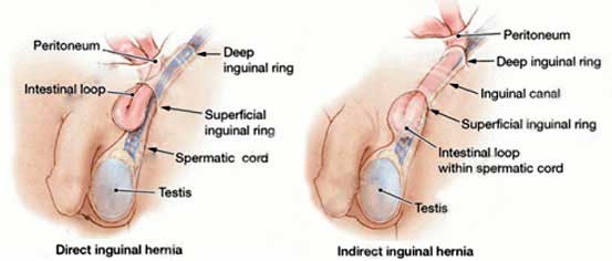Inguinal Hernias / Hydroceles Cost Treatment Open and Laparoscopic Surgery in Mumbai Chennai Delhi Kolkata Hyderabad Bangalore Pune Ahmedabad India