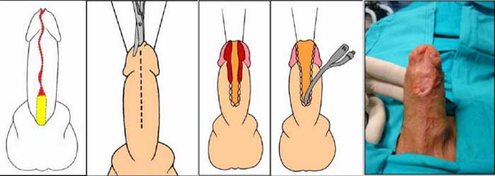 Johanson's Urethroplasty for Adult Urethral Strictures in India