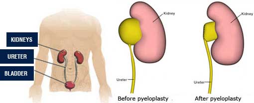 Laparoscopic Pyeloplasty Surgery in India