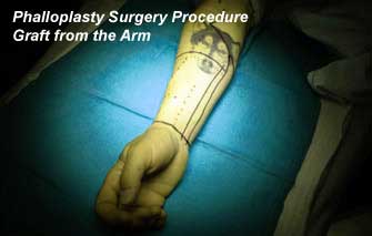 Phalloplasty Surgery Procedure - Graft from the arm in India