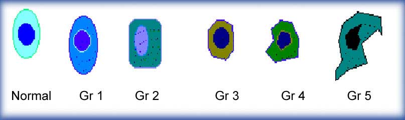 Prostate Intraepithelial Neoplasia Grade or Gleason Grade