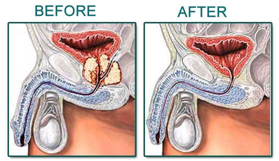 Robotic Prostate Surgery in India