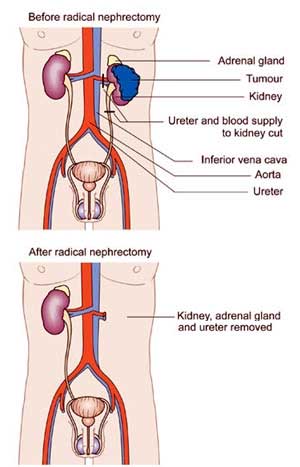 Radical Nephrectomy Surgery in India