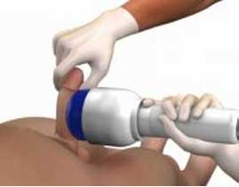 Shockwave therapy Cost in India