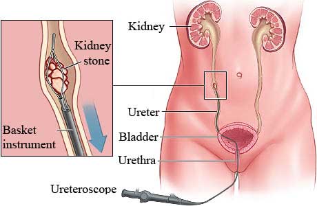 Ureteroscopy in India