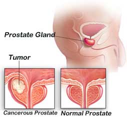 Prostate Cancer and Erectile Dysfunction