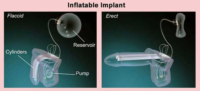 Malleable Vs Inflatable Penile Prosthesis, which one is better?