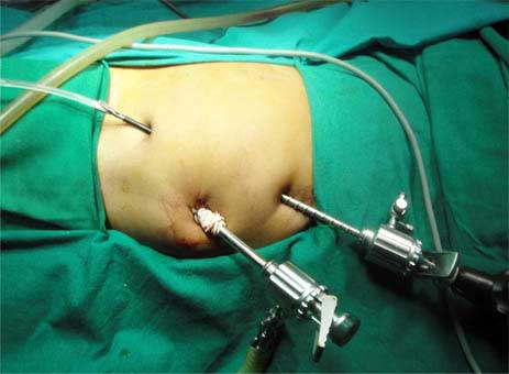 Laparoscopic Pyeloplasty Treatment Surgery Cost in Mumbai Chennai Delhi Kolkata Hyderabad Bangalore Pune Ahmedabad India