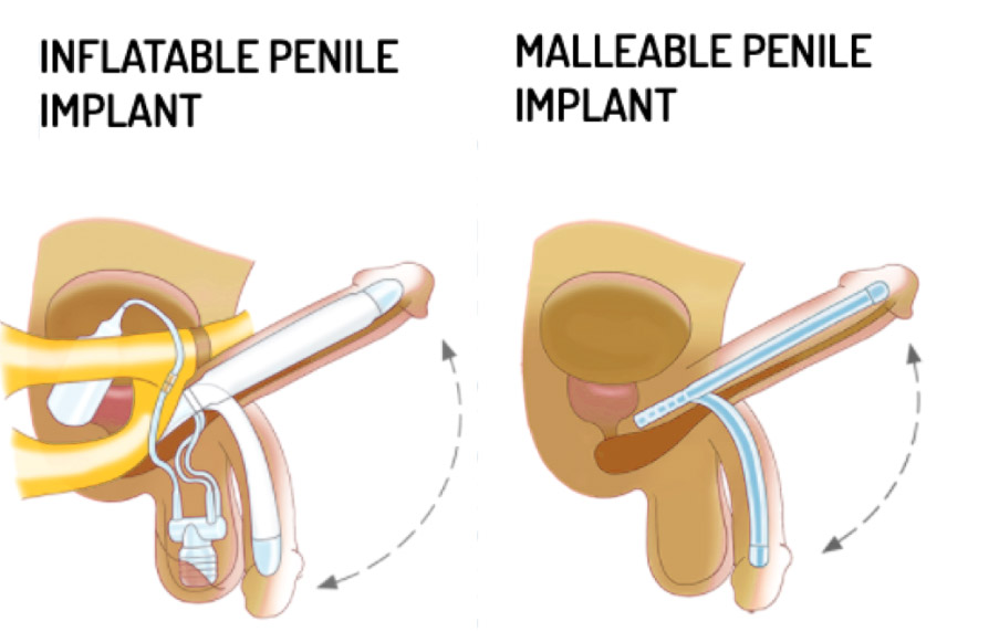 malleable penile implant vs inflatable penile implant