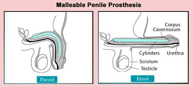 Malleable Vs Inflatable Penile Prosthesis, which one is better?