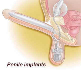 Prostate Cancer - Penile Implants Treatment in India
