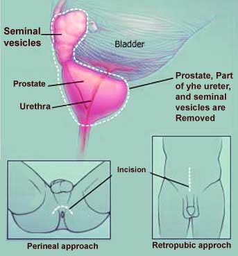 Radical Prostatectomy Treatment Surgery Cost in Mumbai Chennai Delhi Kolkata Hyderabad Bangalore Pune Ahmedabad India